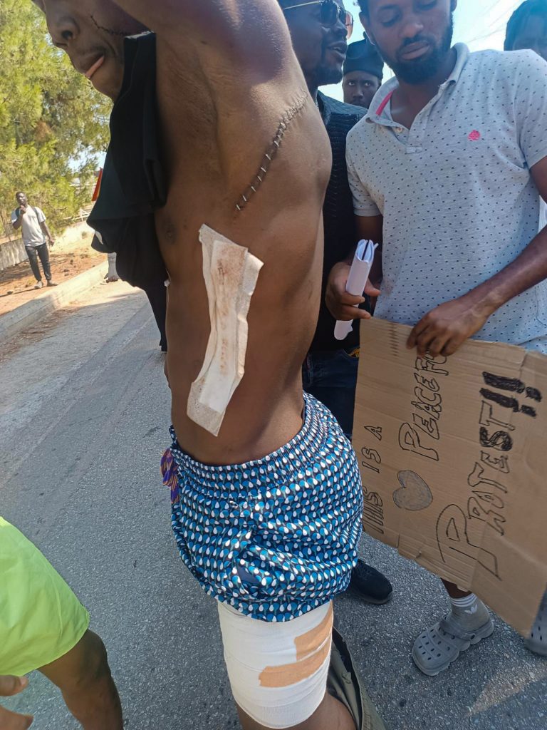 Un hombre muestra sus heridas en una protesta contra la violencia en el campo de refugiados de Malakasa I Foto: SOS Refugiados
